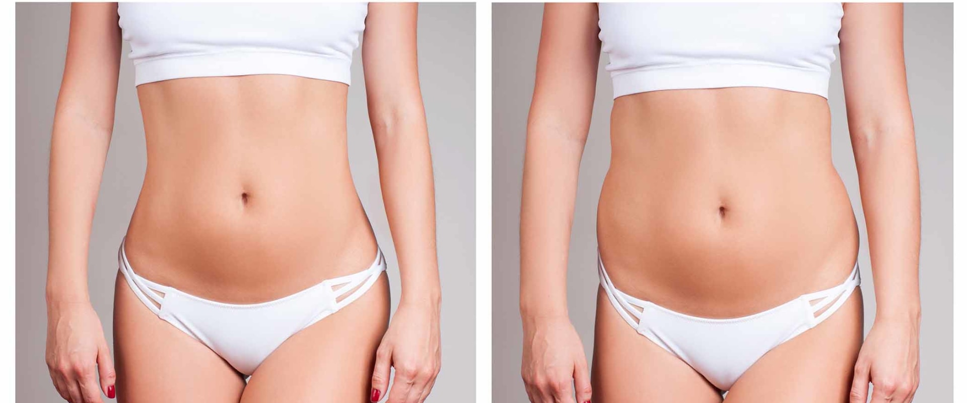 How Long Do the Results of Fat Reduction Treatments Last?