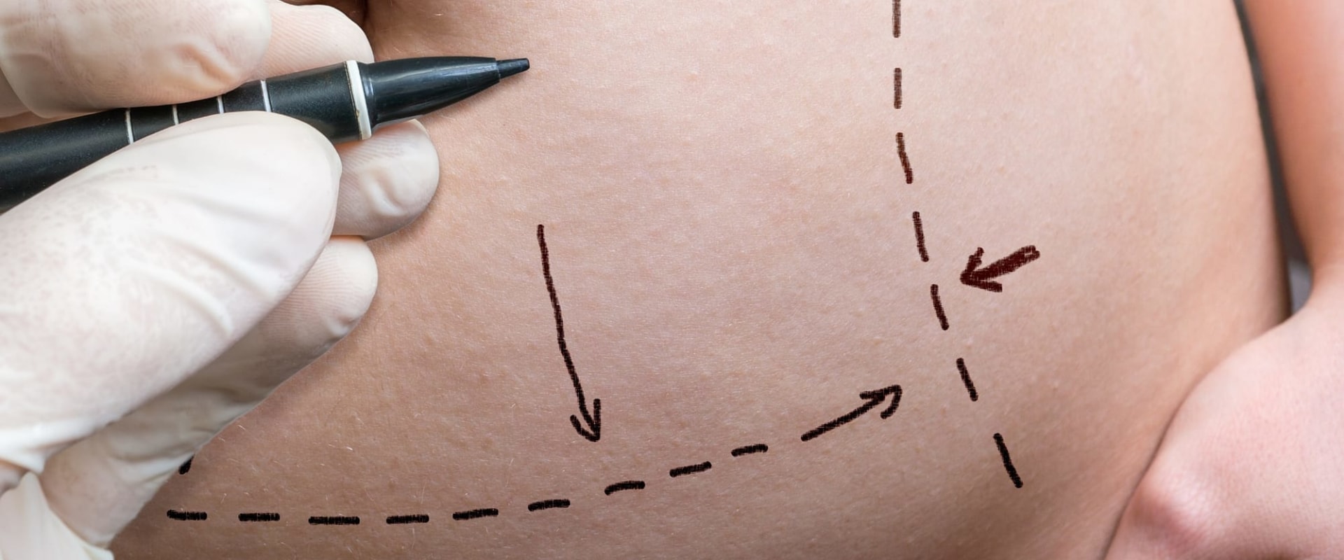 8 Popular Non-Invasive Fat Reduction Procedures