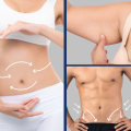 Non-Invasive Fat Reduction: What Areas of the Body Can Be Treated?