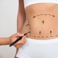 Comparing Liposuction and CoolSculpting: Which Fat Reduction Treatment is Right for You?