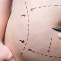 What Does Fat Reduction Do? A Comprehensive Guide